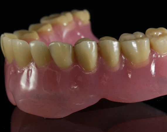 Vertex ThermoSens тотална протеза
